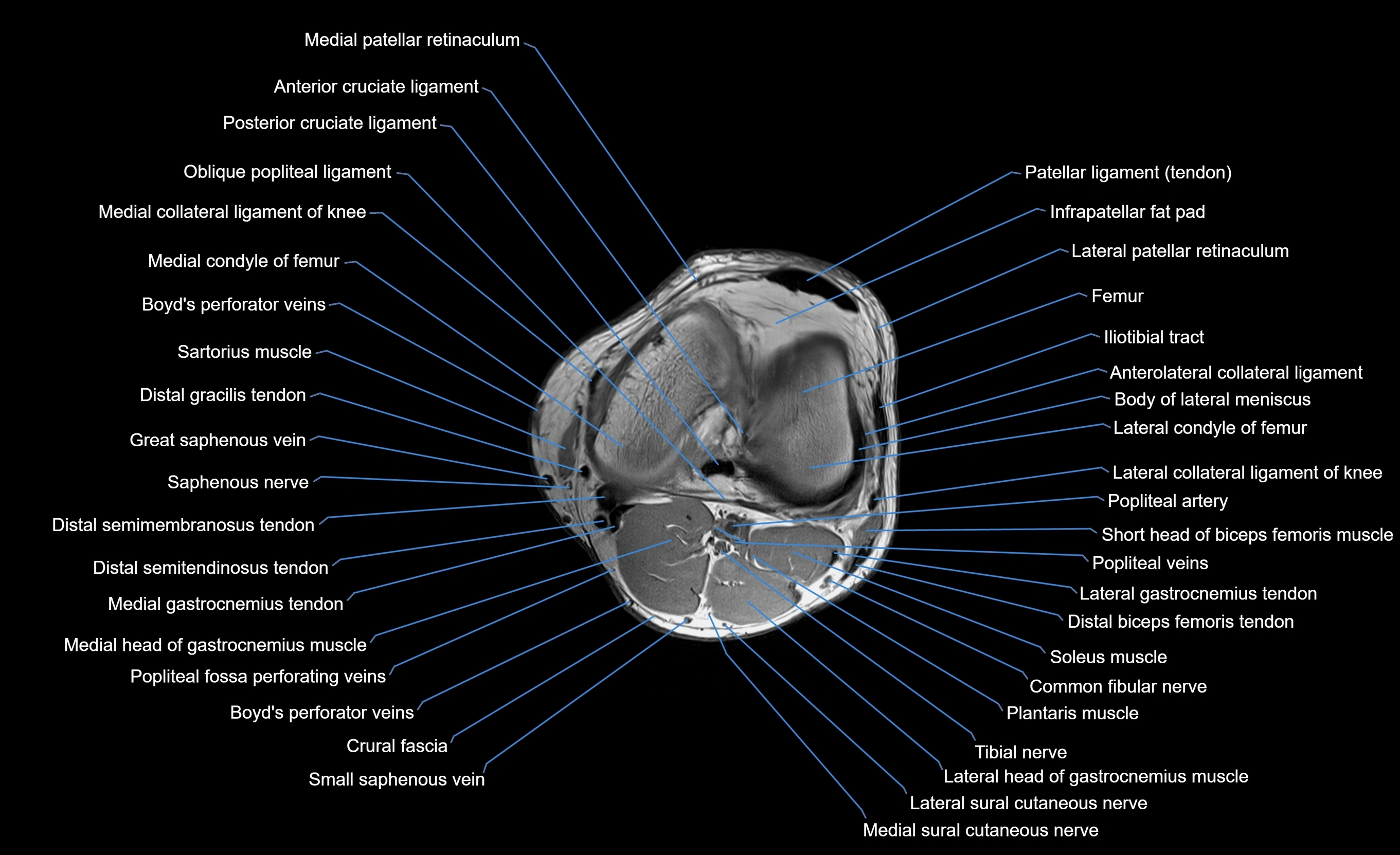 MRI lower leg axial cross sectional anatomy 3T  radiology  image-img-00001-00015.webp